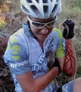 Cyclist with bleeding arm