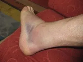 An ankle with bruising along the foot