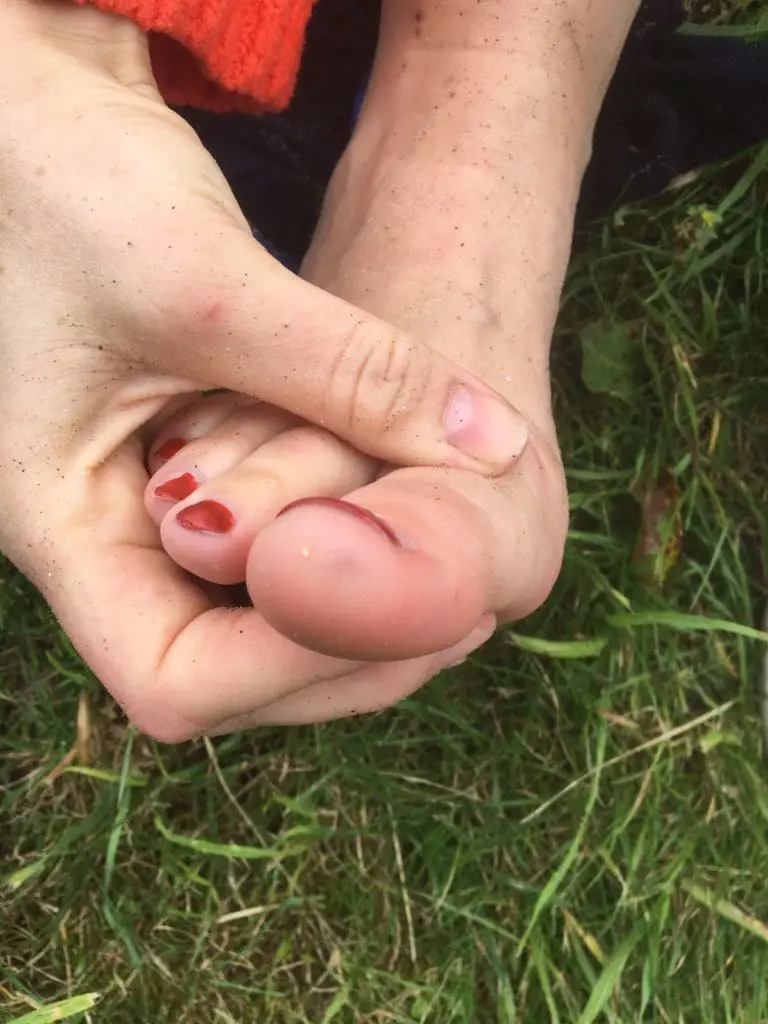 A weever fish sting