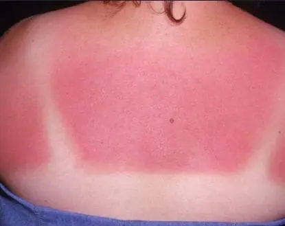 A badly sun burnt back