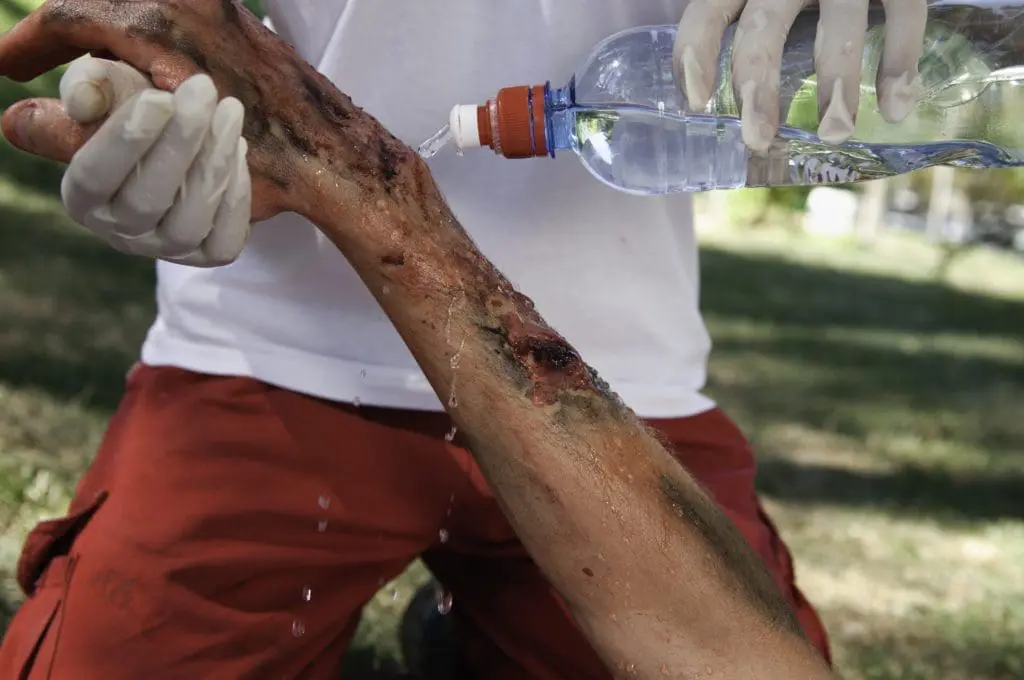 burned arm