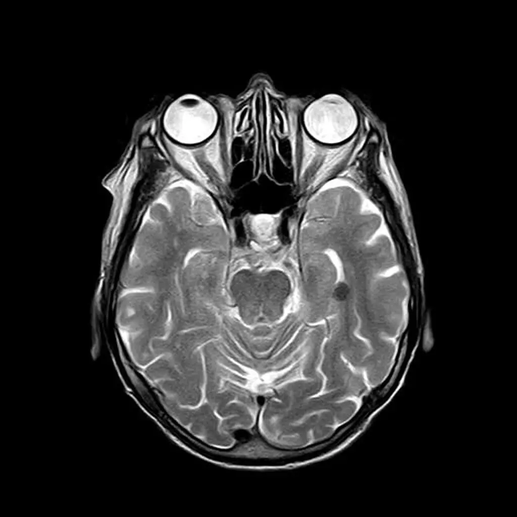 An MRI scan of a healthy human brain