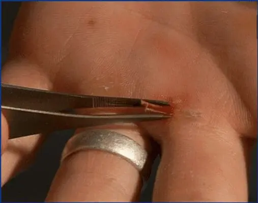 Removing a splinter with tweezers