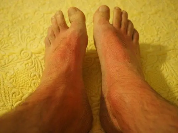 Feet with obvious sunburn marks showing the shadow of sandals.