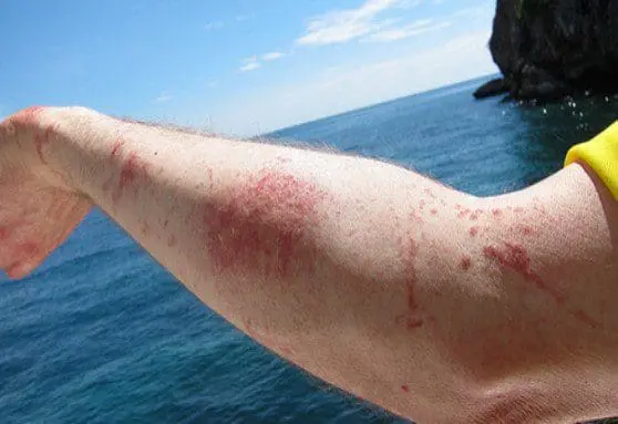 Jellyfish stings to a persons arm