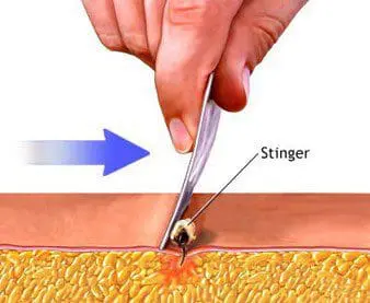 Scraping a bee sting out of the skin using a credit card